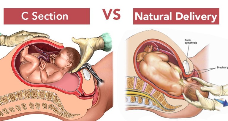 Benefits of vaginal delivery on pelvic girdle pain